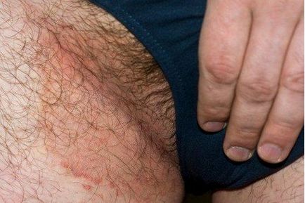 Зачервяване в областта на слабините при мъже отколкото лечение, причини и симптоми (мъже) Зачервяване в областта на слабините при мъже отколкото лечение, причини и симптоми