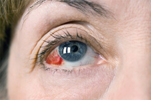 Повреда на роговицата на окото, лечение, последствията, ексфолиране, реставрация