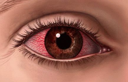 Причини и лечение на червени очи у дома