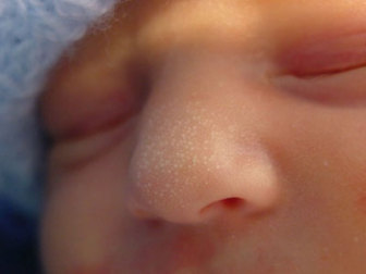 Пъпки по лицето, защото от това, което се появява на новородено и какво да прави с тях