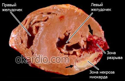 Скъсване на сърцето води, видове, симптоми и лечение, прогнозата за живот