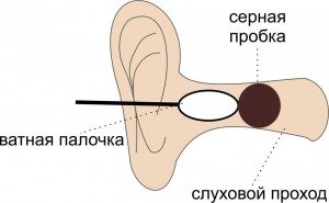Ушна кал в симптомите на ухо, е възможно да се премахне като у дома си, ABC Здраве