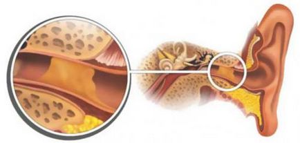 Ушна кал в симптомите на уши, какво да се прави при лечението и как да го премахнете