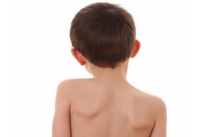 Сколиоза при деца причинява симптомите, лечение и профилактика