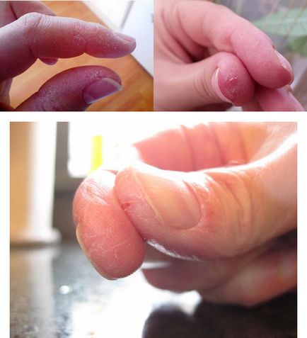 Пукнатини в пръстите причини за лечение с мехлеми, домашни грижи