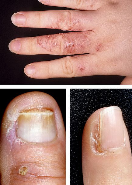 Пукнатини в пръстите причини за лечение с мехлеми, домашни грижи