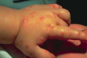 Ухапвания от насекоми при децата снимка, отколкото лечение, оказване на първа помощ при ухапвания от комари, пчели и оси