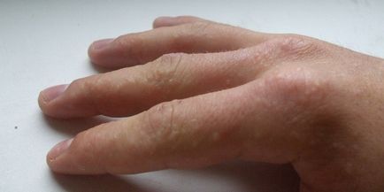 Мехури по пръстите на ръцете - причините за сълзящи кожни обриви, и лечение