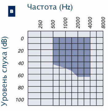 Възстановяване на слуха във всички форми на загуба на слуха