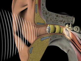 Вродена загуба на слуха е риск от загуба на слуха в новородени, тестът за загуба и лечение на заболявания на слуха