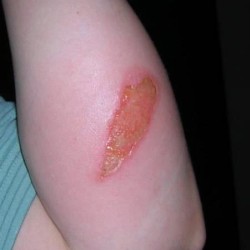 Химическите изгаряния на лечение на кожата в домашни условия и оказване на първа помощ