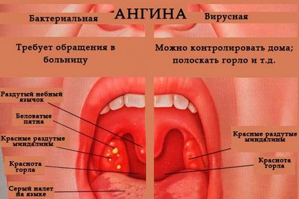 Смятате тонзилит заразна за другите гноен (фоликуларна), бактериални, вирусни (инфекциозни) Има болки в гърлото е заразен с другите гноен (фоликуларна), бактериални, вирусни