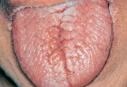 Изгарянето език причини и лечение, възможни заболявания, превенция