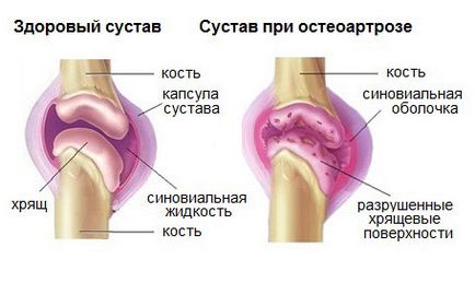 Инжекциите alflutop какво