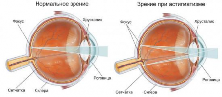 Астигматизмът при децата какво е