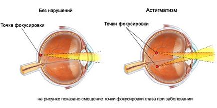Астигматизмът при децата какво е