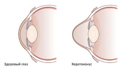 Астигматизмът при децата какво е