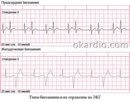 Bigemini какво е