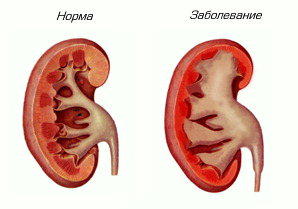 Какво е заболяване на бъбреците