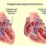 степен на сърдечна недостатъчност
