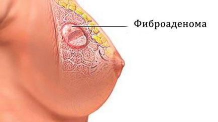 лечение Fibroadenomatosis гърдата