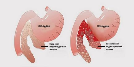 Какво е панкреатит панкреаса