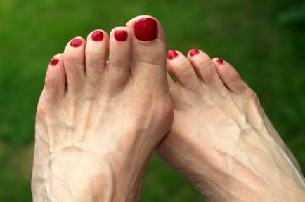 Пъпки по лечението на крака народни средства