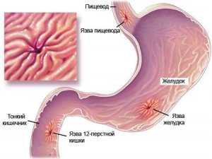 Схемата на лечение на стомашни язви