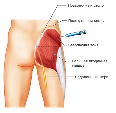 Как да се постави на инжекциите седалищните