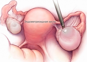 Защо се образуват кисти