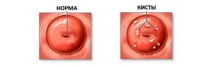 лечение ендоцервикалните кисти