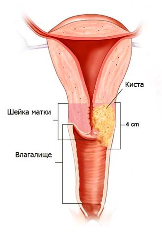 лечение ендоцервикалните кисти