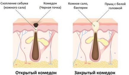 Какво е комедони по лицето