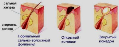 Комедони по лицето (отворени, затворени), какво е то, ка се отърве от причините за