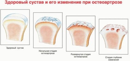 лечение polyosteoarthrosis