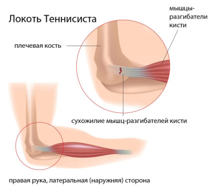 Лечение за тенис лакът