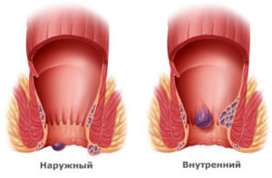 Какви са хемороиди от това, което той