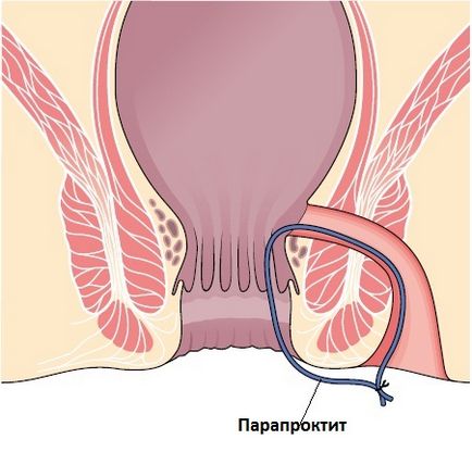 Какви са хемороиди от това, което той