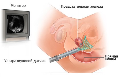 подготовка Uzi простатата