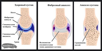 лечение polyosteoarthrosis