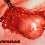 лечение Fibroadenomatosis гърдата