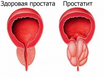 Простатит симптоми при мъжете