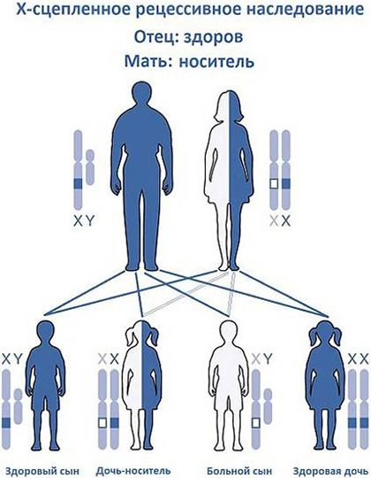 синдром на Морис е това, което е