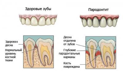 пародонтит степен