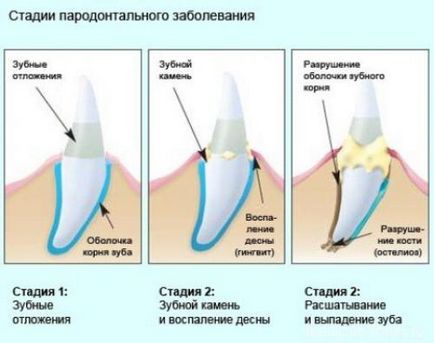 пародонтит степен