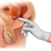Простатит симптоми при мъжете