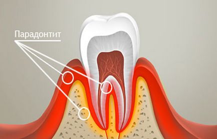 пародонтит степен