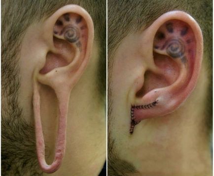 Какво е тунел в ухото