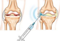 Инжекциите alflutop какво