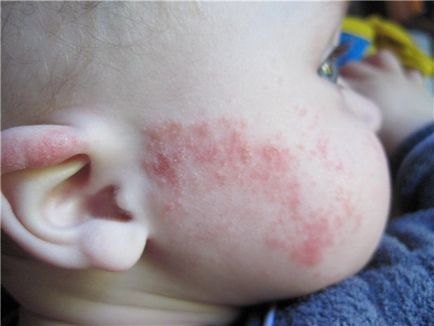 11 Най-често срещаните видове алергии при децата - детски симптоми на алергия